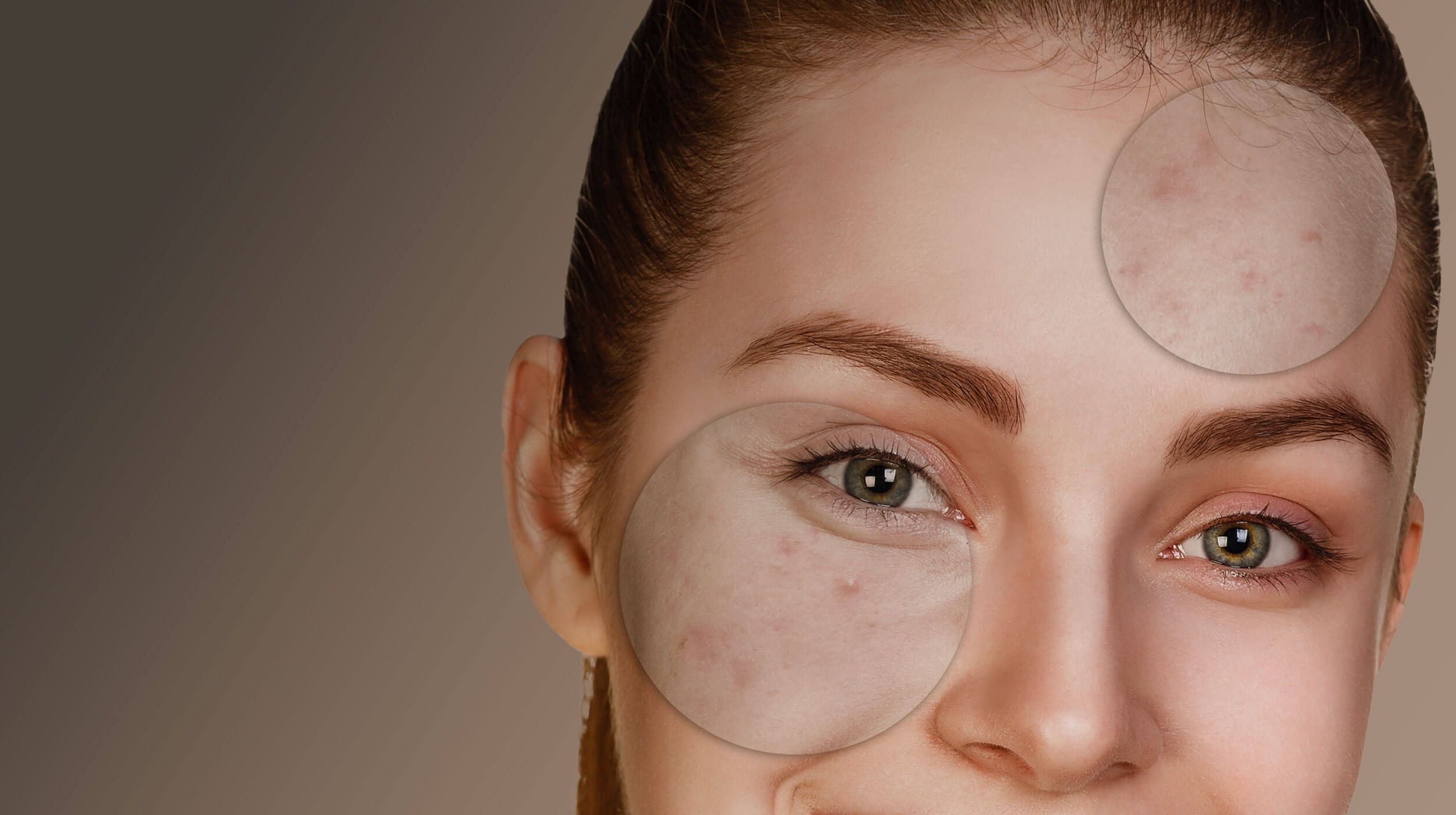 Ακμή σε πρόσωπο γυναίκας – εικόνα με σημεία ακμής και ουλών στο μέτωπο και τα μάγουλα, για ενημέρωση & αντιμετώπιση. 