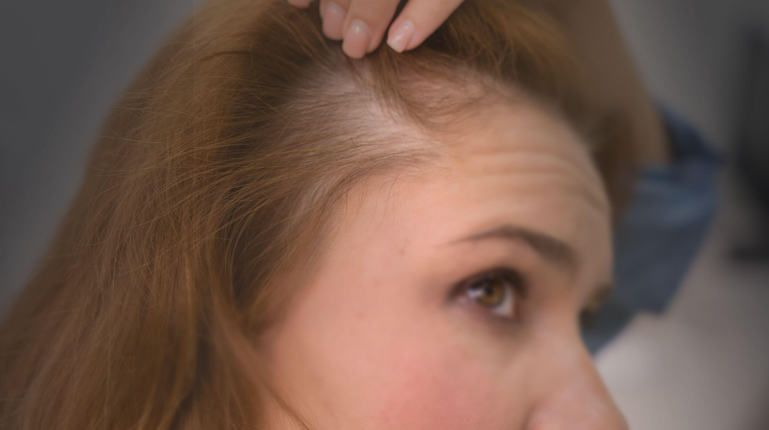 Γυναίκα με σημάδια αλωπεκίας ανασηκώνει τα μαλλιά της και εμφανίζεται αραίωση στο πλάι του τριχωτού της κεφαλής. 