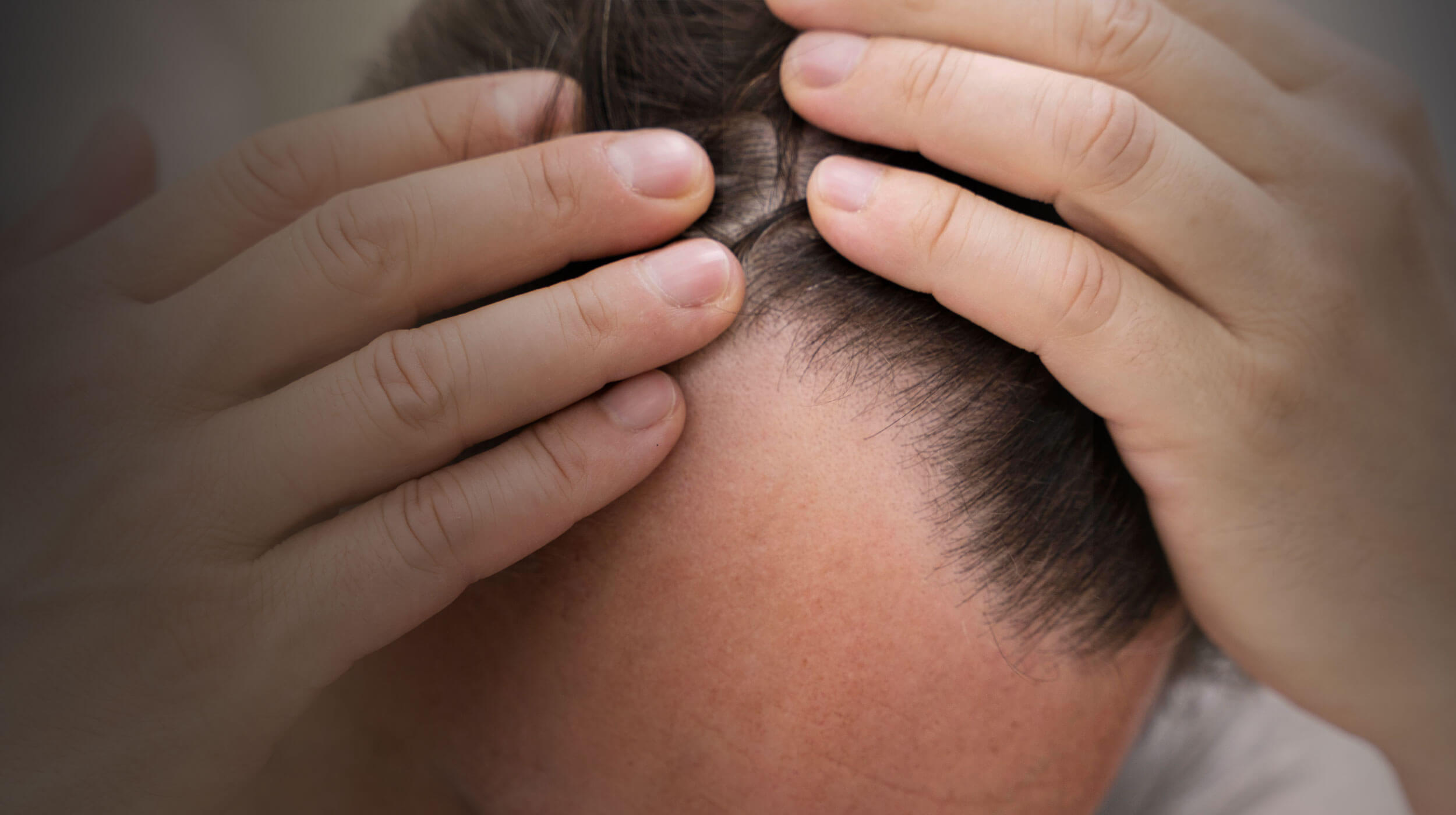 Άνδρας που αποκαλύπτει την περιοχή του μετώπου και των κροτάφων, δείχνοντας εμφανή αραίωση μαλλιών.