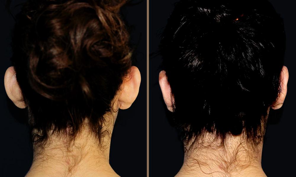 otoplasty-002