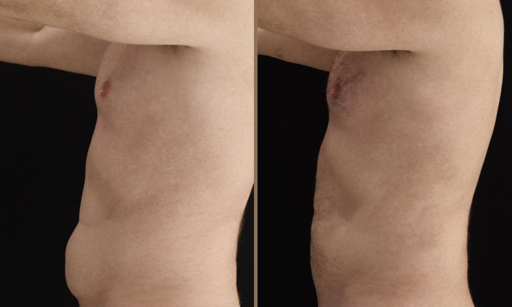 argon plasma koilia 9