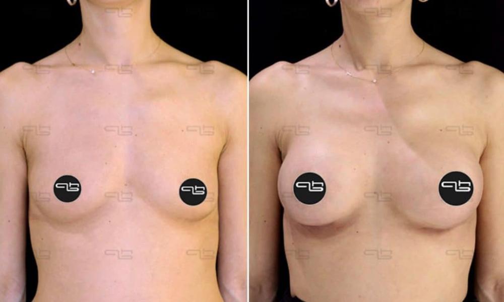 auksitiki-stithous-00015