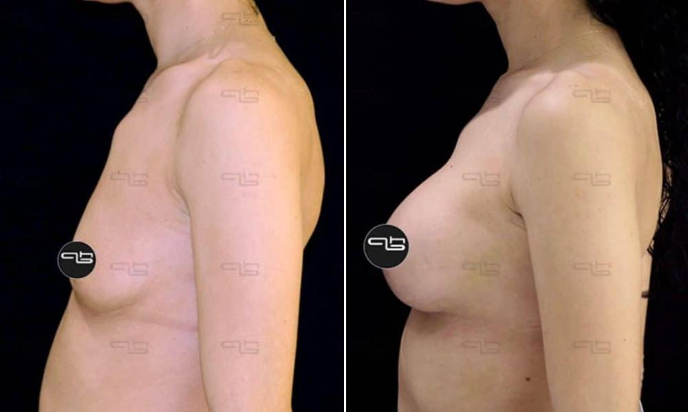 auksitiki-stithous-00016