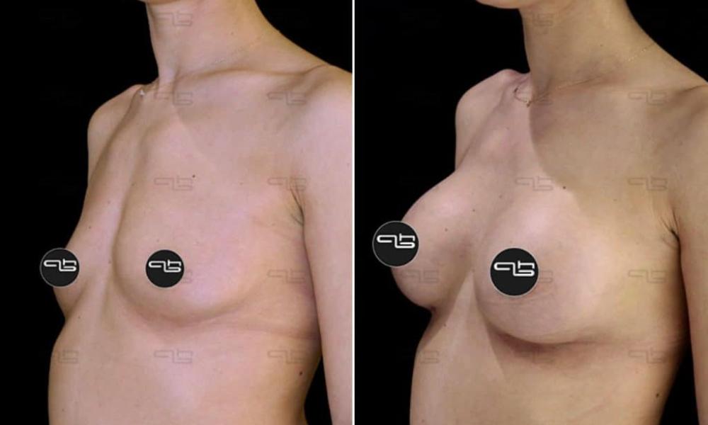 auksitiki-stithous-00017