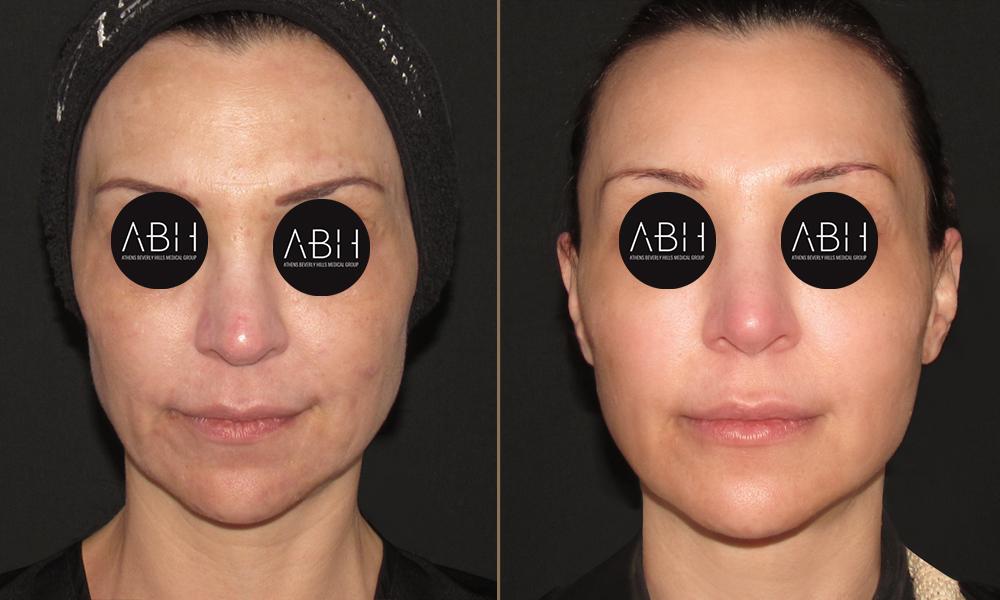 DLIFT anagnostopoulou