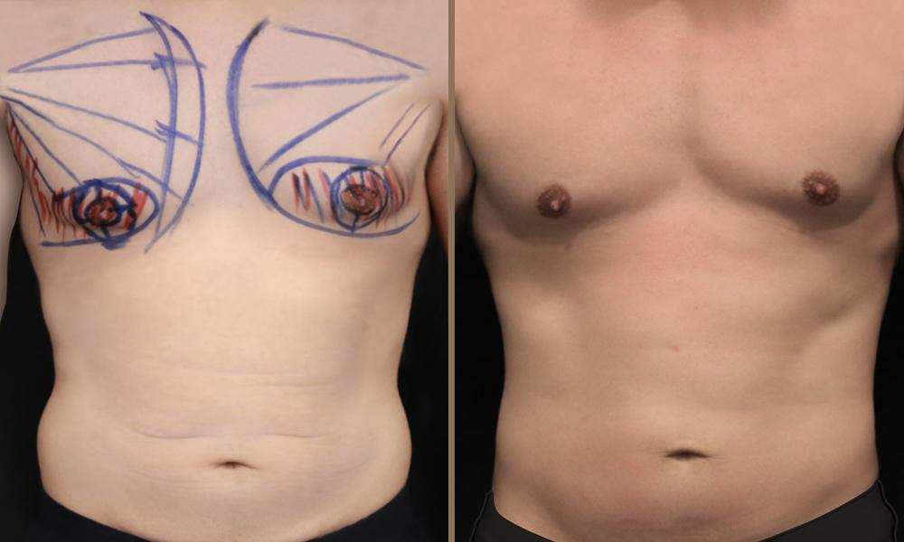 argon-plasma-stithos