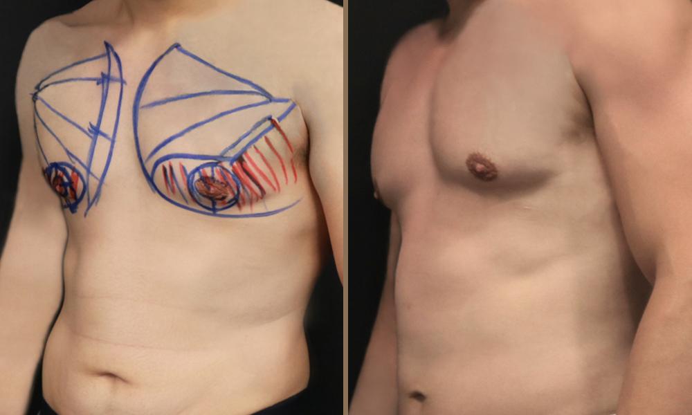 argon-plasma-stithos2