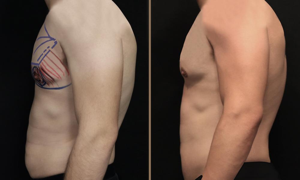 argon-plasma-stithos3