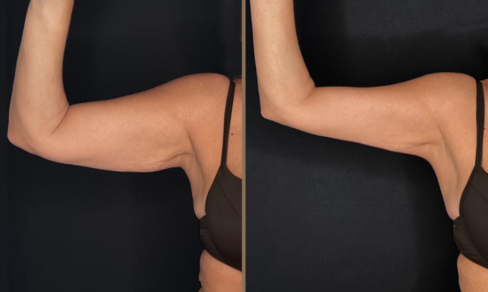 athanasaki-fotini-arms- A