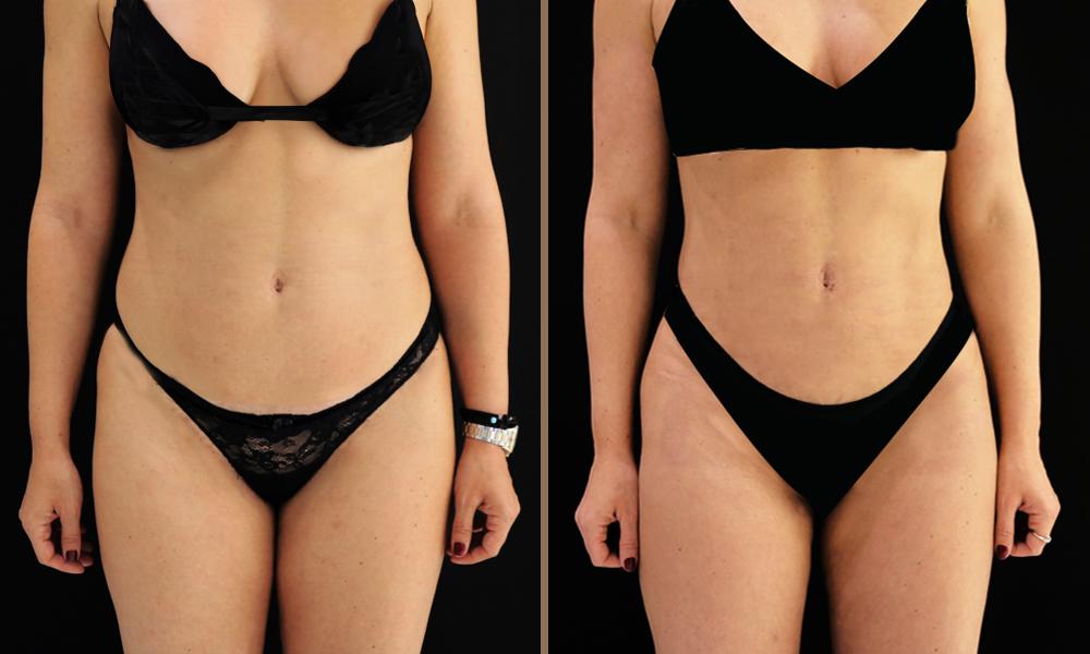 lipo-vaser-andritsopoulou-marilena-a