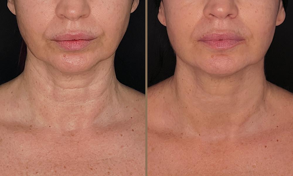 thermage argiroula A