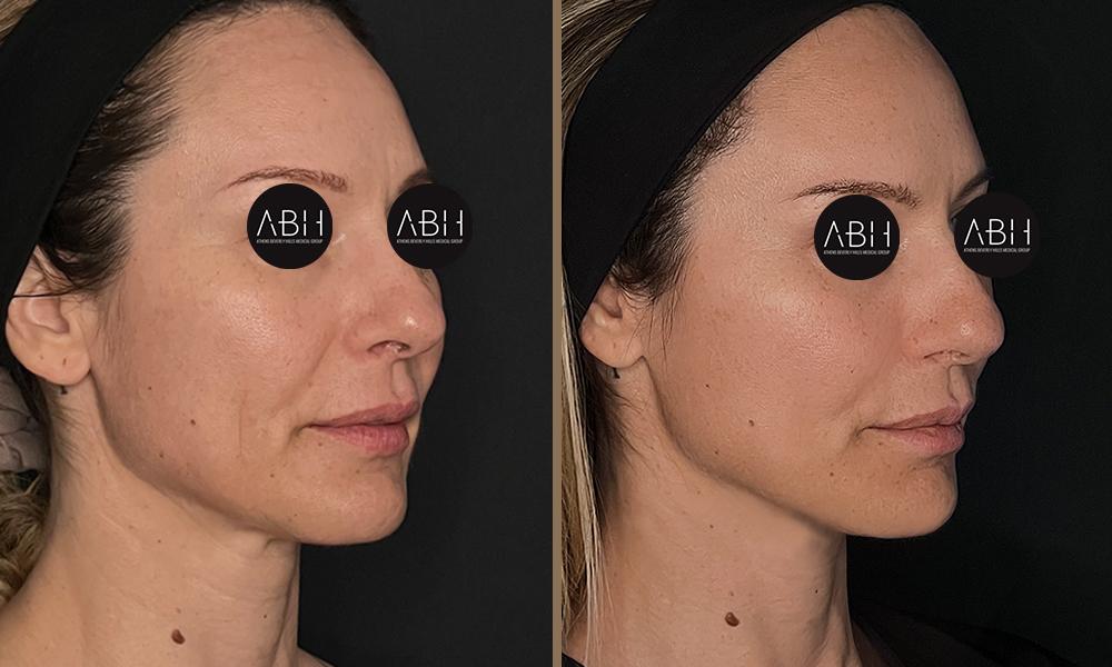 Beau_D_Fill stanescu B