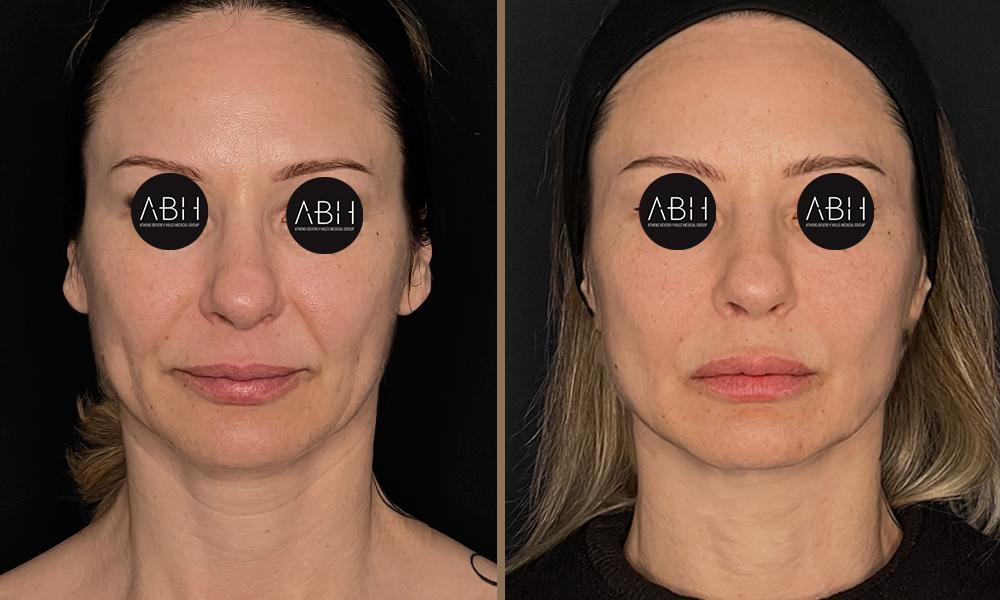 Beau_D_Fill stanescu A