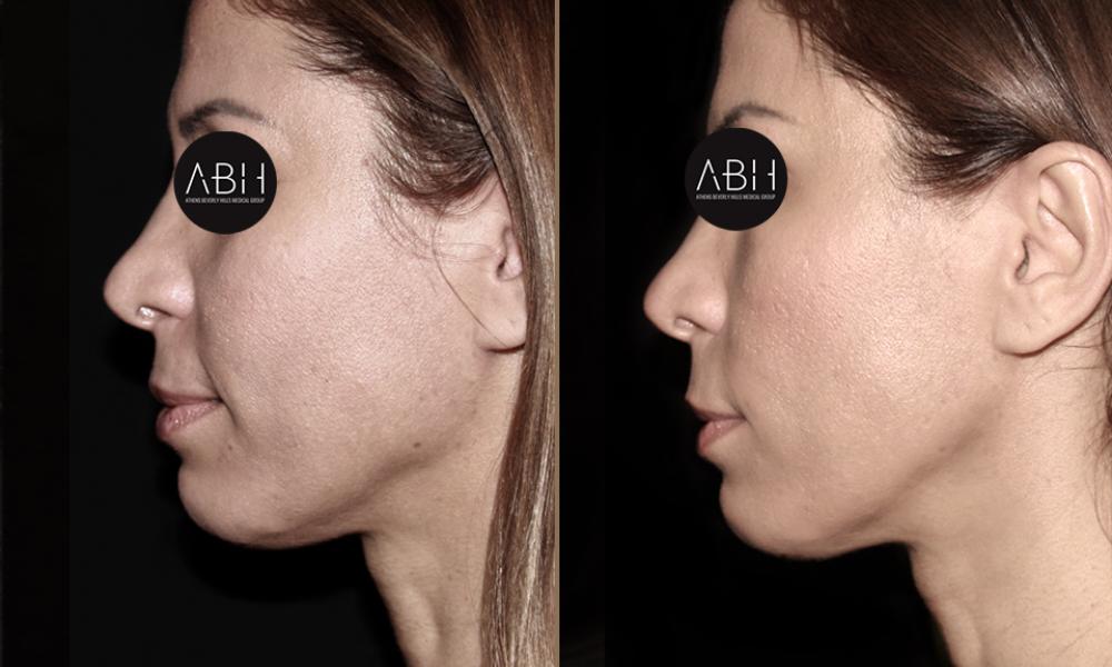 Beau_D_Fill vasilikaki A