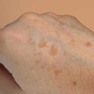 Χέρι με εμφανείς δυσχρωμίες και πανάδες, ενδείξεις φωτογήρανσης και γήρανσης της επιδερμίδας. 