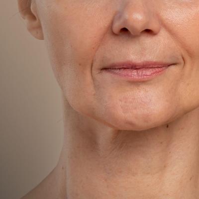 Κοντινό πλάνο του λαιμού και του προσώπου μιας γυναίκας, με εμφανείς λεπτές ρυτίδες και απώλεια ελαστικότητας.