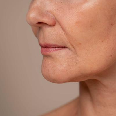 Κοντινό πλαϊνό πλάνο γυναικείου προσώπου, με εμφανή απώλεια όγκου στην περιοχή γύρω από το πηγούνι και τα μάγουλα. 