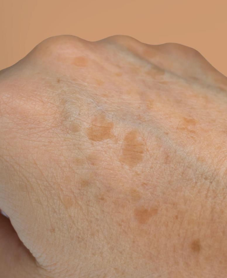 Χέρι με εμφανείς δυσχρωμίες και πανάδες, ενδείξεις φωτογήρανσης και γήρανσης της επιδερμίδας. 