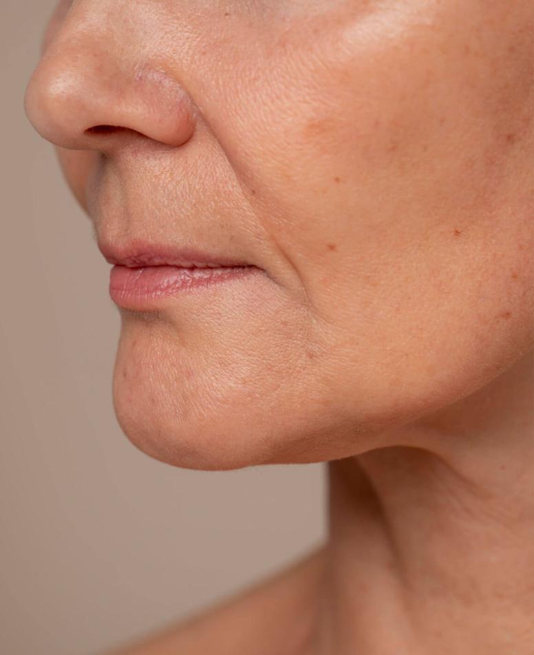 Κοντινό πλαϊνό πλάνο γυναικείου προσώπου, με εμφανή απώλεια όγκου στην περιοχή γύρω από το πηγούνι και τα μάγουλα. 