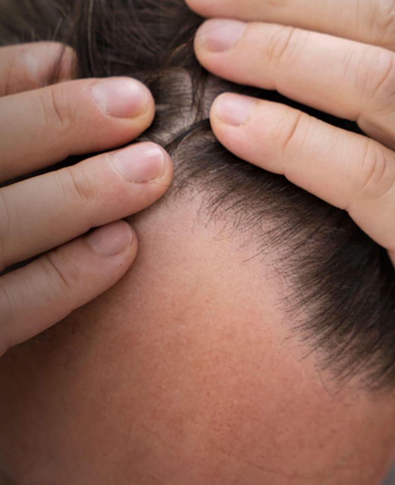 Άνδρας που αποκαλύπτει την περιοχή του μετώπου και των κροτάφων, δείχνοντας εμφανή αραίωση μαλλιών.