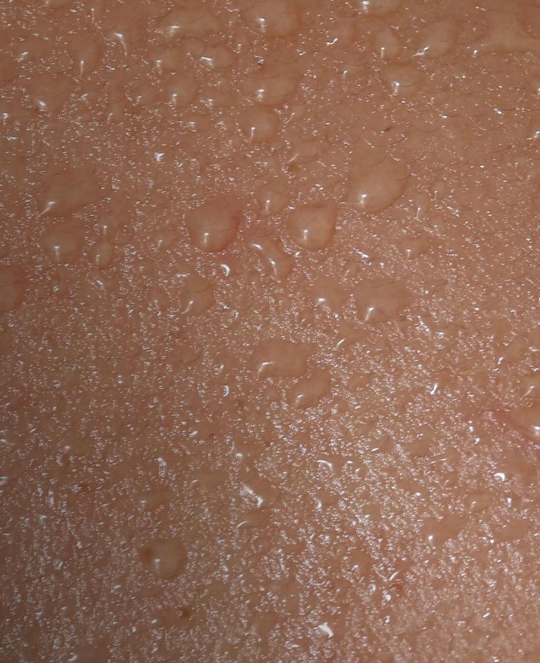 Υπεριδρωσία